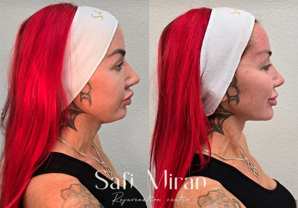 Jawline contouring result before and after