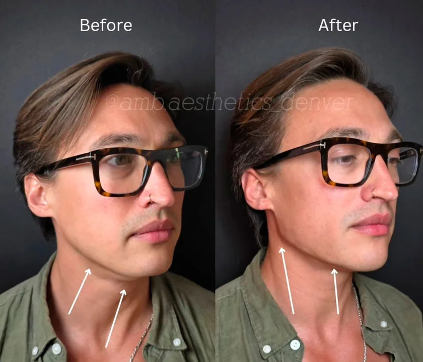 Male jawline contouring before and after result