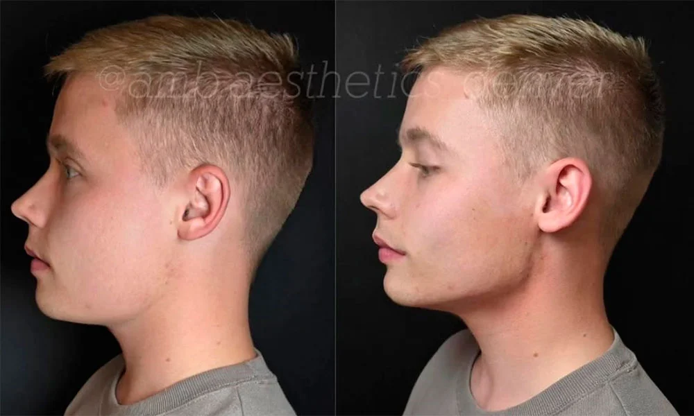 Jawline contouring before and after for men