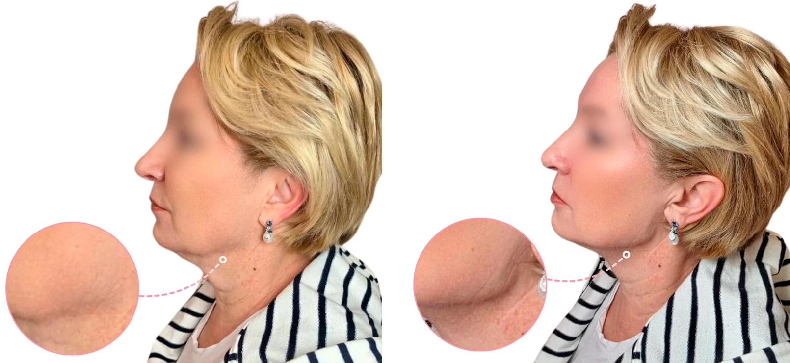 Jawline contouring treatment before and after