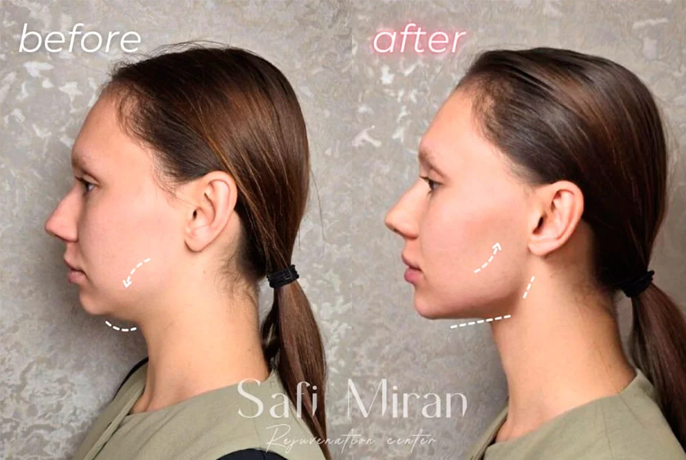 Before and after jawline definition treatment