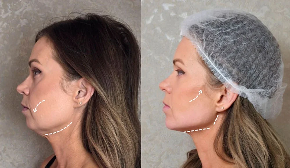 Jawline shape before and after contouring