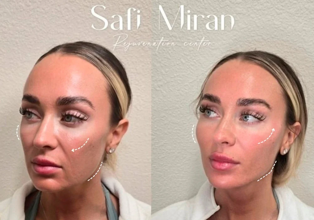Facial profile before and after jawline contouring