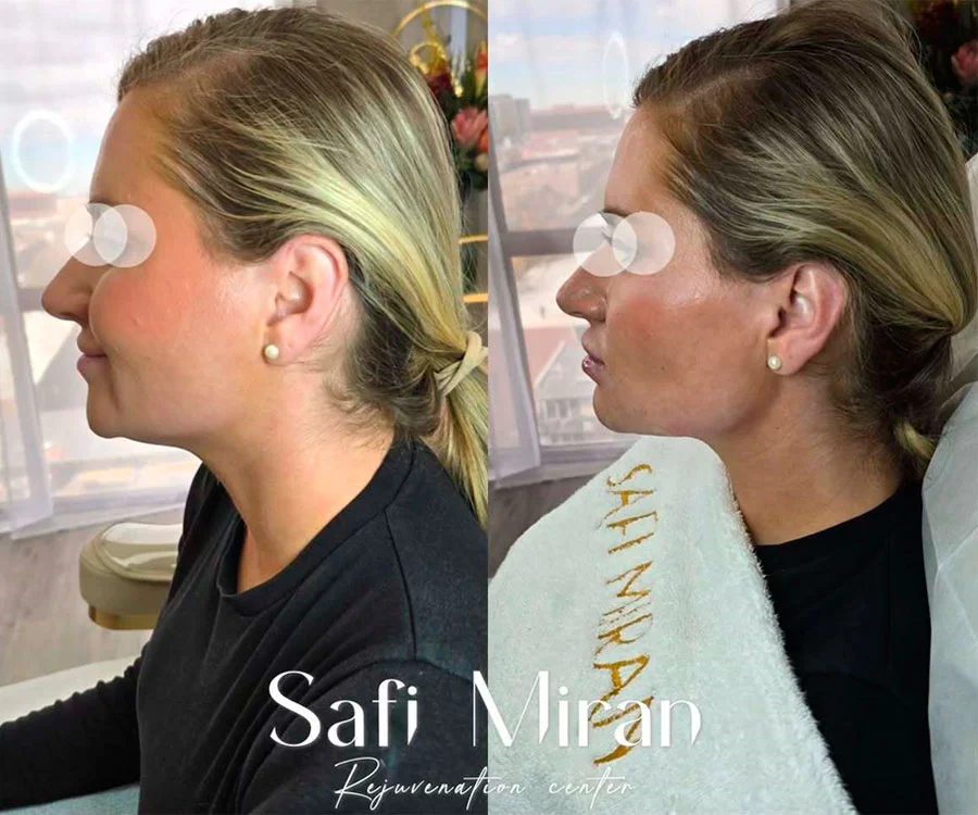 Jawline contouring before and after photo