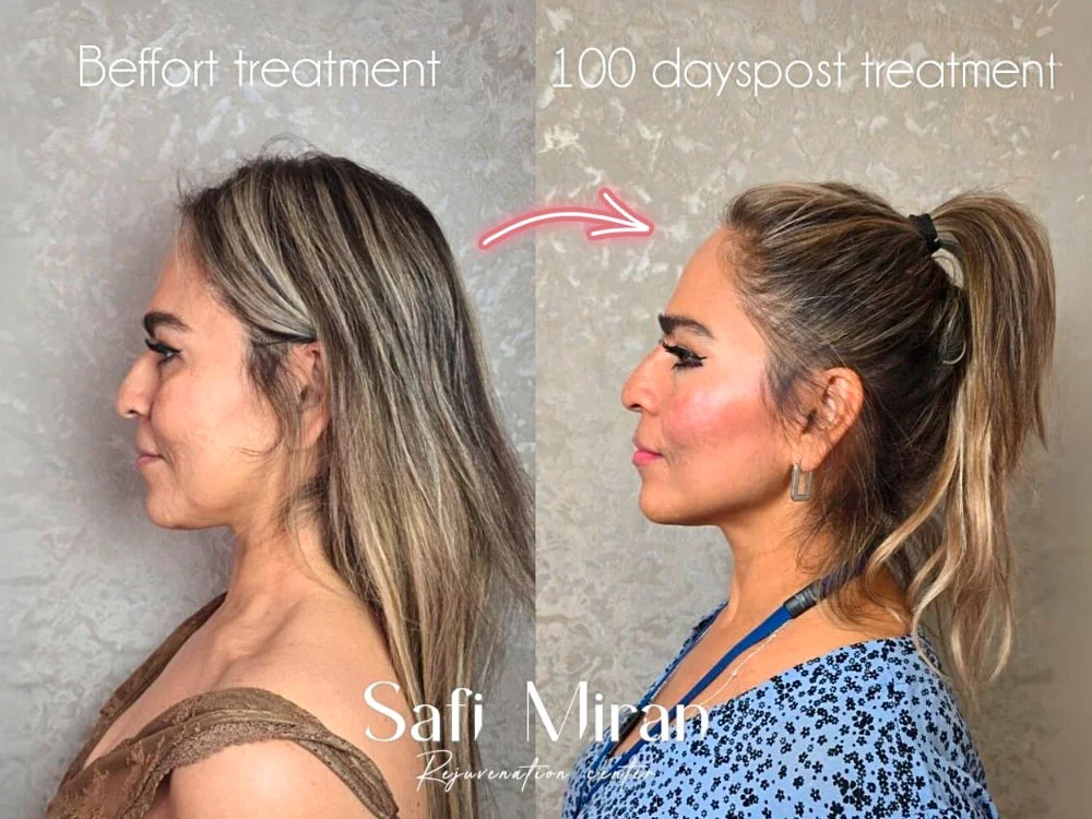 Lower face before and after jawline contouring