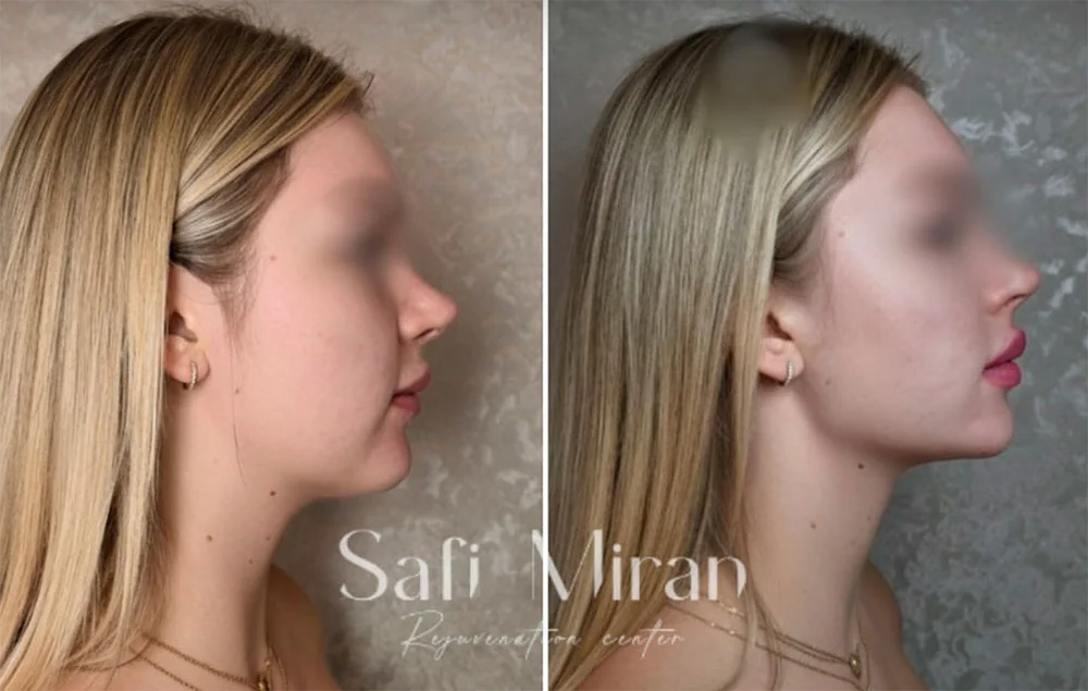 Jawline definition before and after contouring