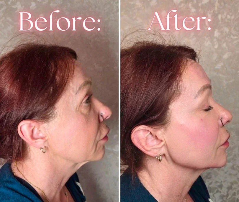 Jawline contouring before and after transformation