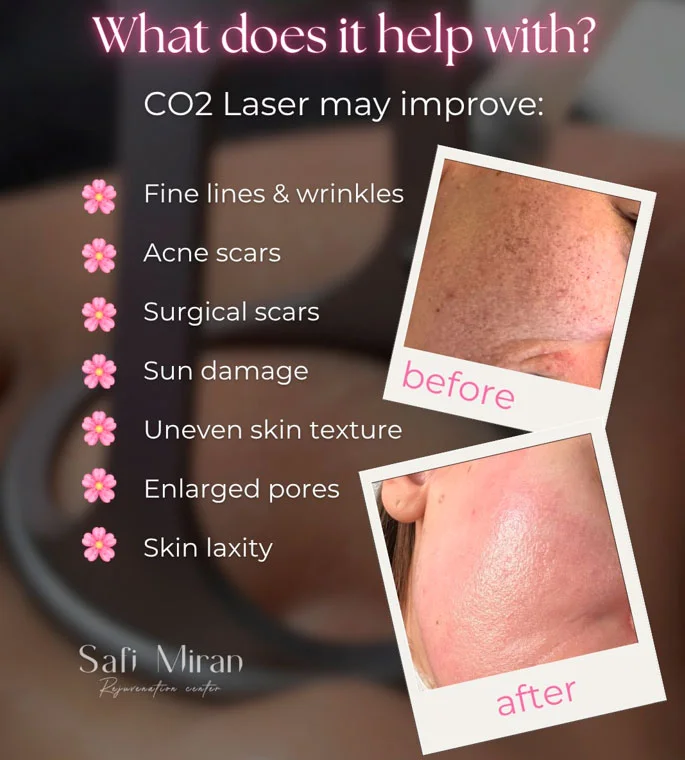 Skin concerns that CO2 laser treatment can help improve