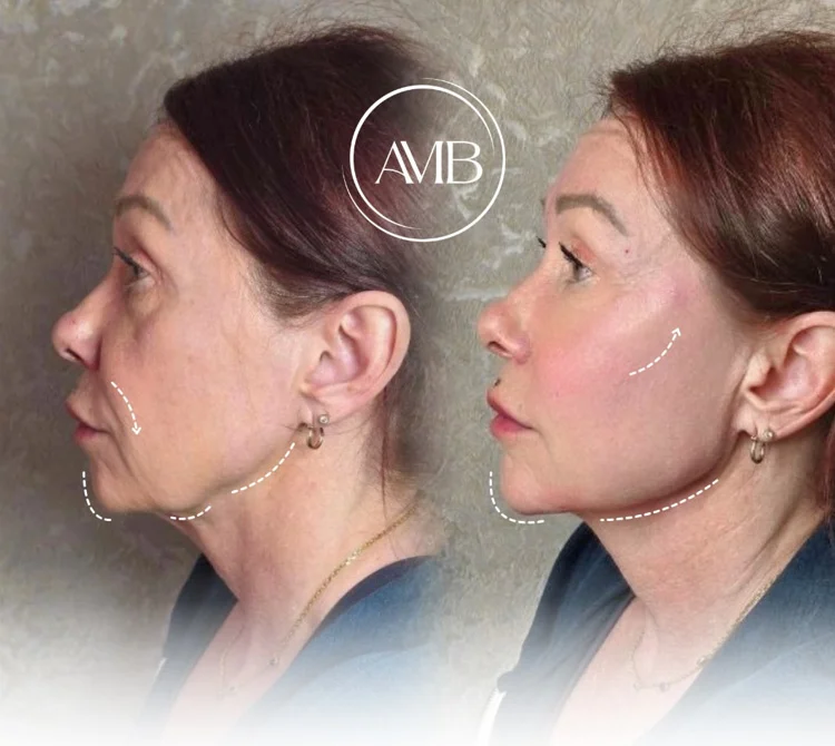 Facial balancing before and after at Safi Miran Denver
