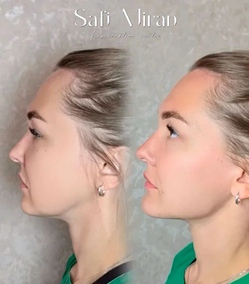 Jawline contouring and chin augmentation before and after result