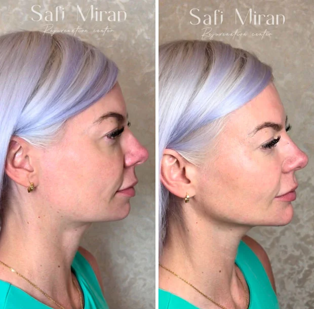 Before and after jawline contouring and chin augmentation