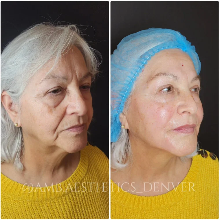Non-surgical face lift before and after result