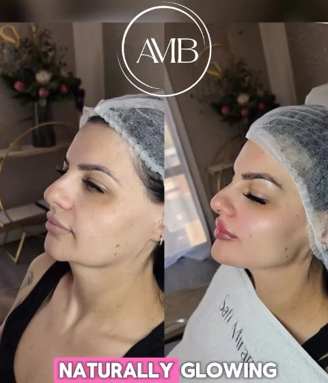 Non-surgical full-face transformation before and after result