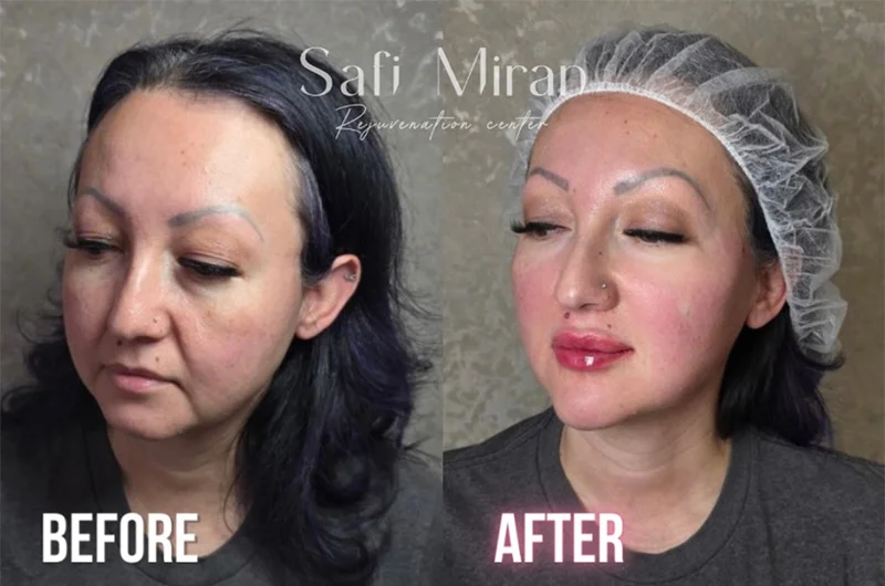Non-surgical full-face transformation before and after photo