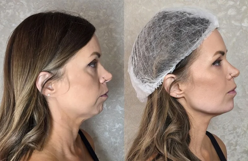 Before and after non-surgical full-face transformation