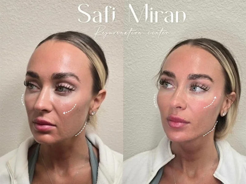 Non-surgical full-face transformation result before and after