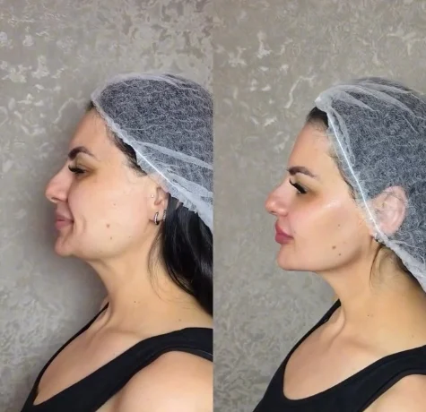 Non-surgical full-face transformation before and after