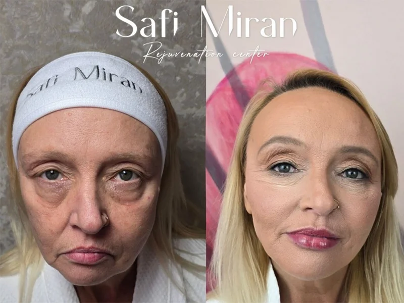 Non-surgical full-face transformation before and after natural-looking result