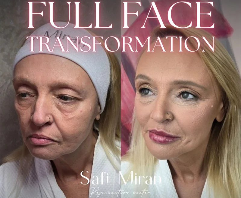Full-face rejuvenation before and after non-surgical transformation