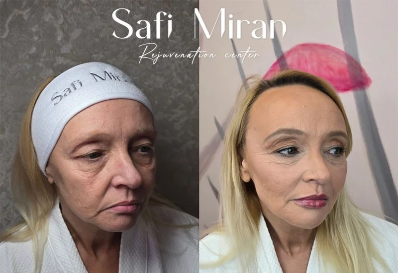Non-surgical full-face transformation before and after facial rejuvenation