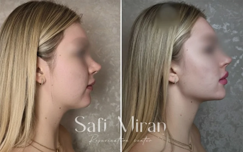 Non-surgical volume and lift before and after result