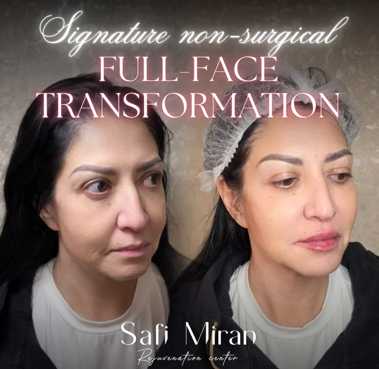 Signature Non-Surgical Full-Face Transformation before and after