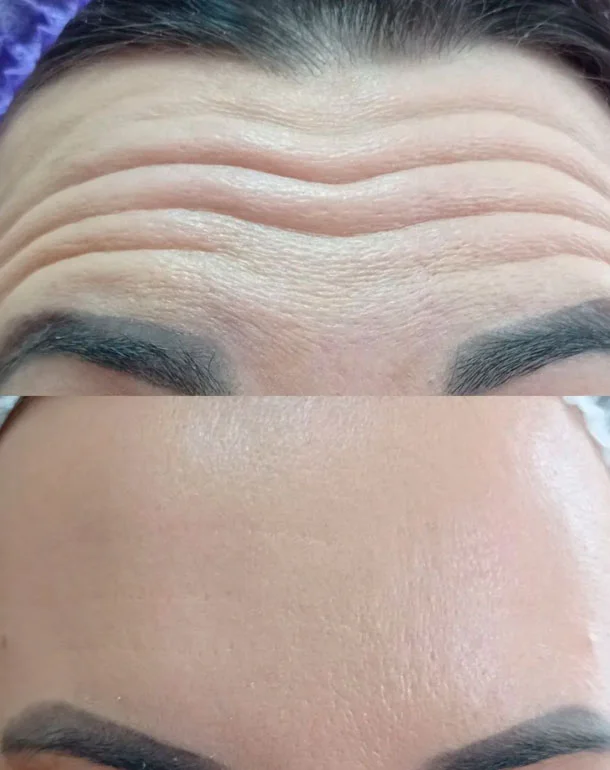 Before and after Botox treatment