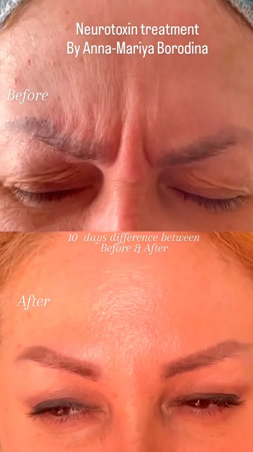 Botox before and after result
