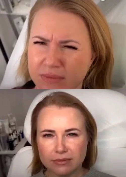 Botox results before and after