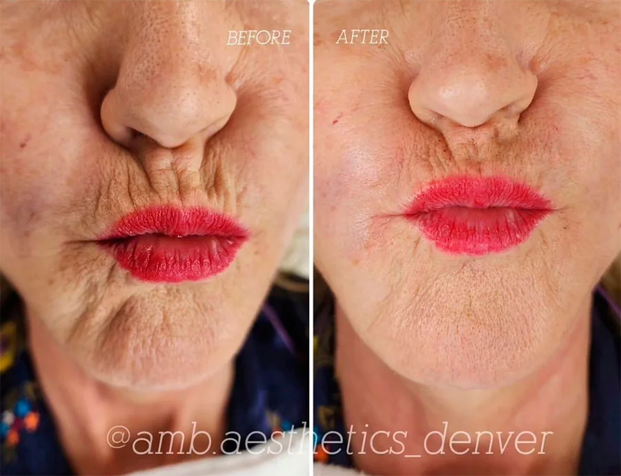 Botox before and after transformation