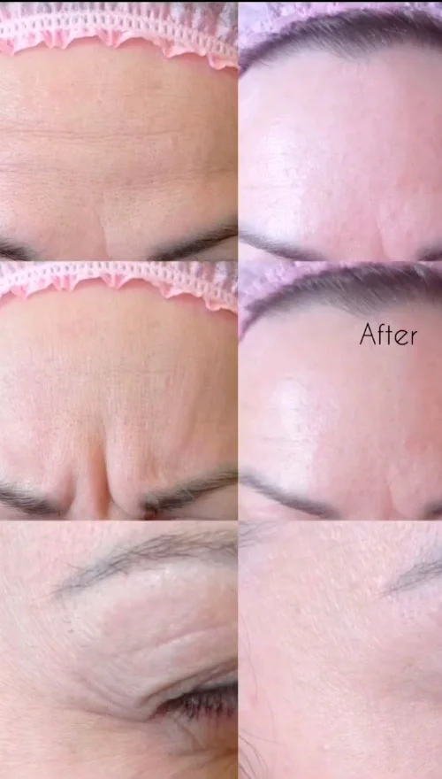 Facial Botox before and after