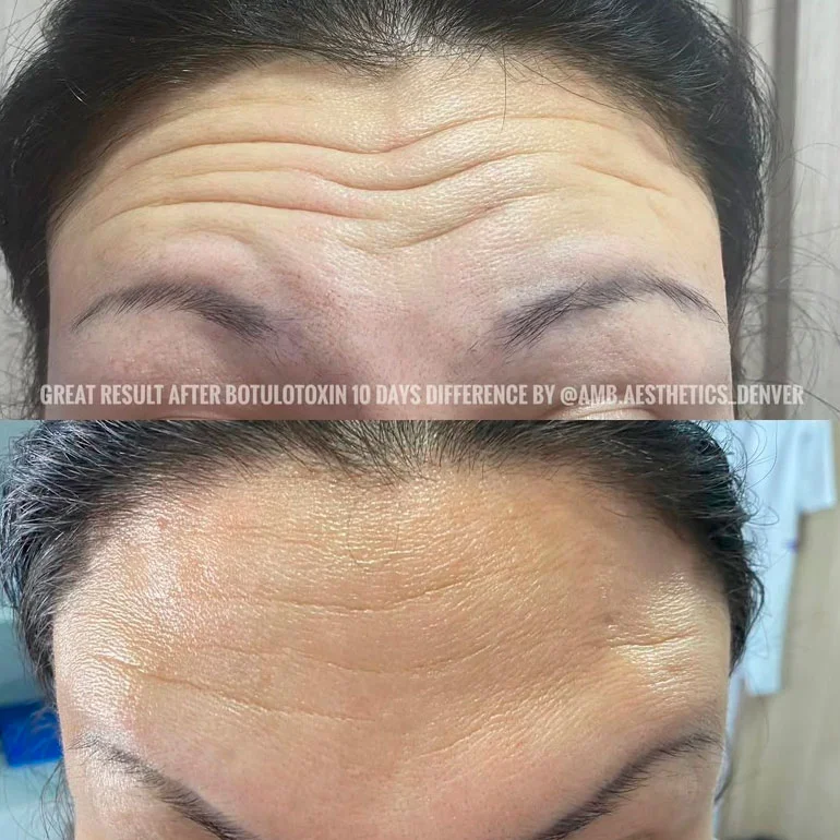 Natural Botox before and after result