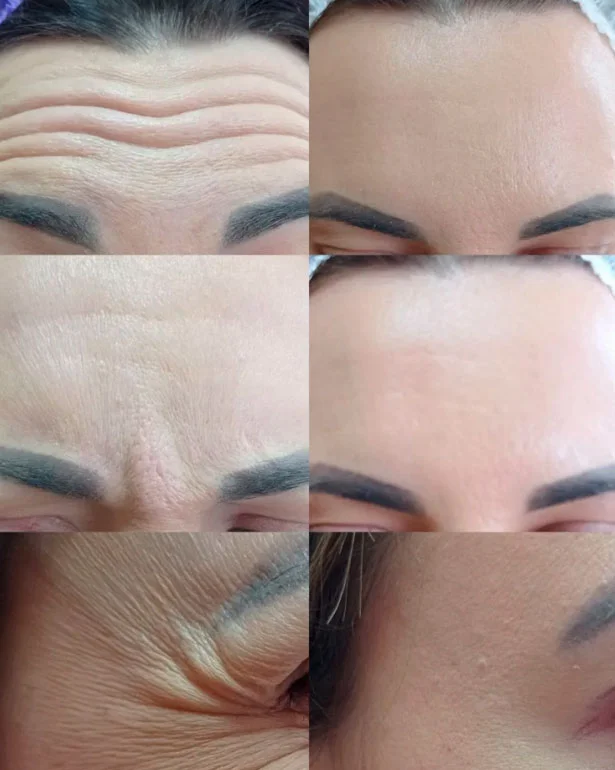 Botox injections before and after result