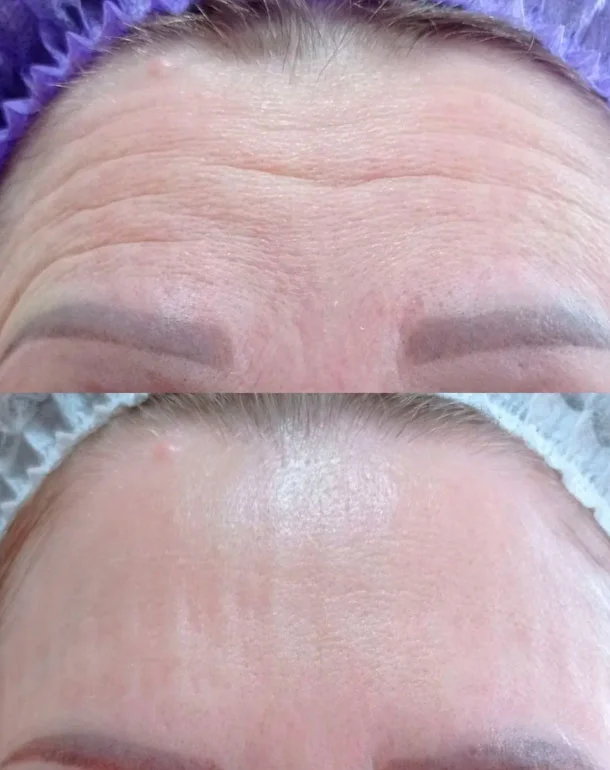 Botox treatment before and after photo