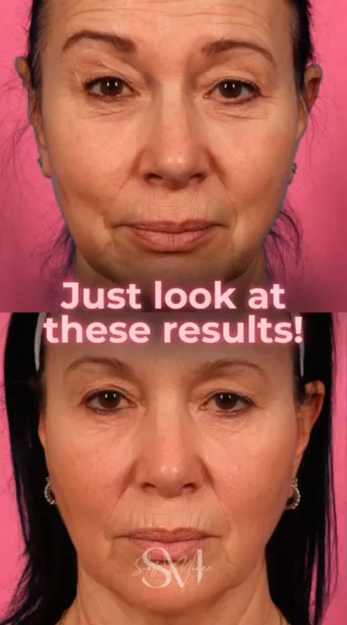 Botox before and after photos