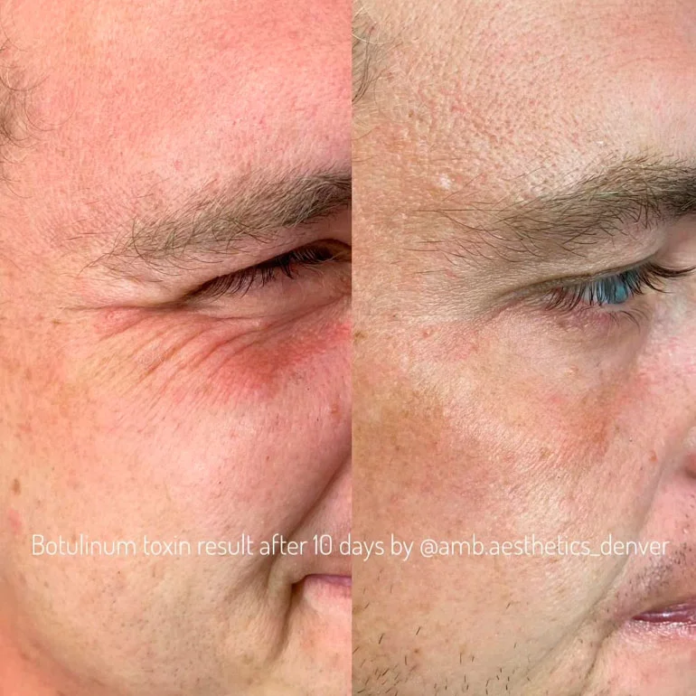 Crow's feet Botox before and after photo