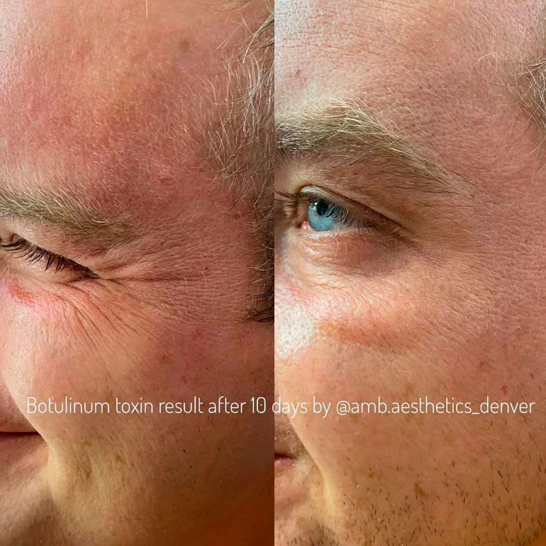 Botox crow's feet before and after result