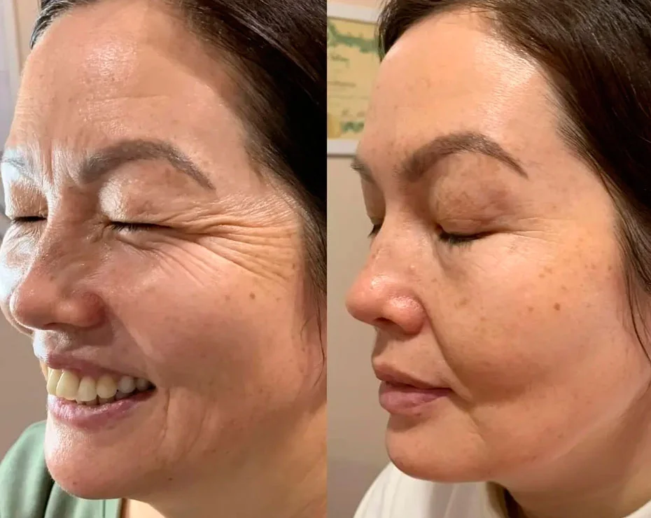 Before and after Botox for crow's feet