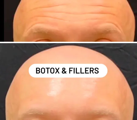 Before and after Botox for forehead lines