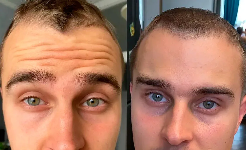 Forehead Botox before and after photo