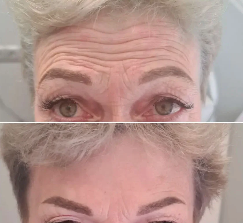 Botox forehead before and after result