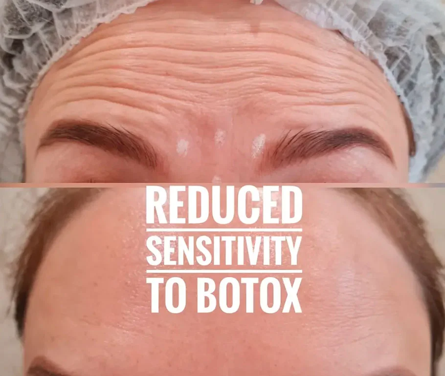 Botox for the forehead before and after