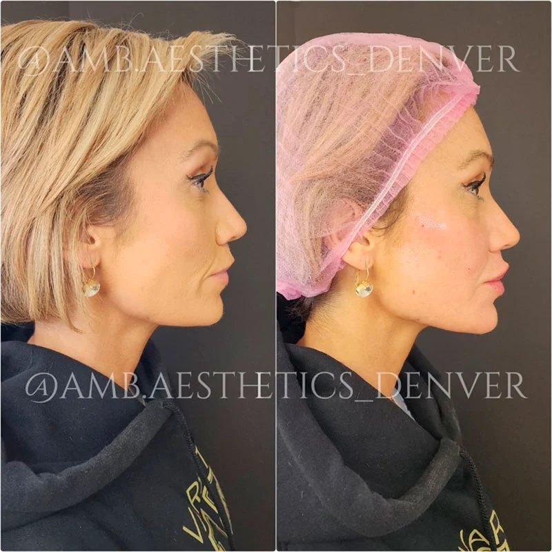 Lower face before and after jawline contouring