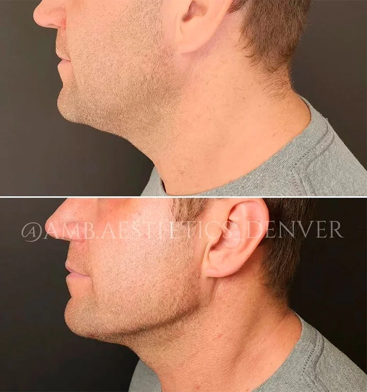 Jawline contouring for men before and after