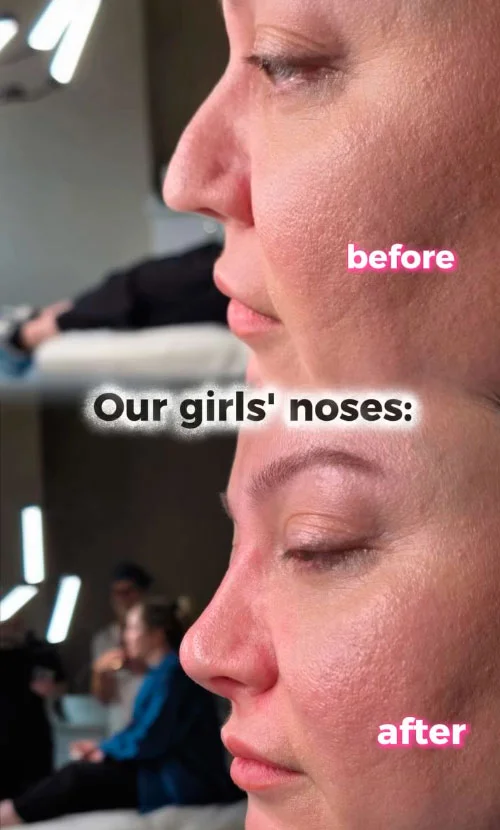 Liquid rhinoplasty before and after result