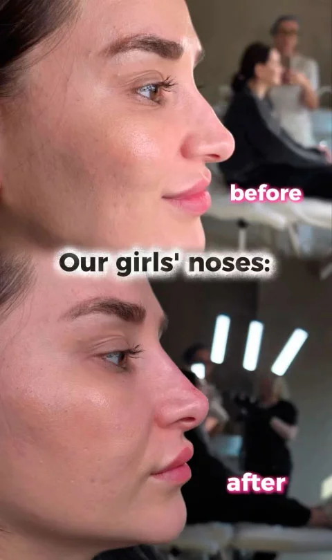 Non-surgical nose job before and after result