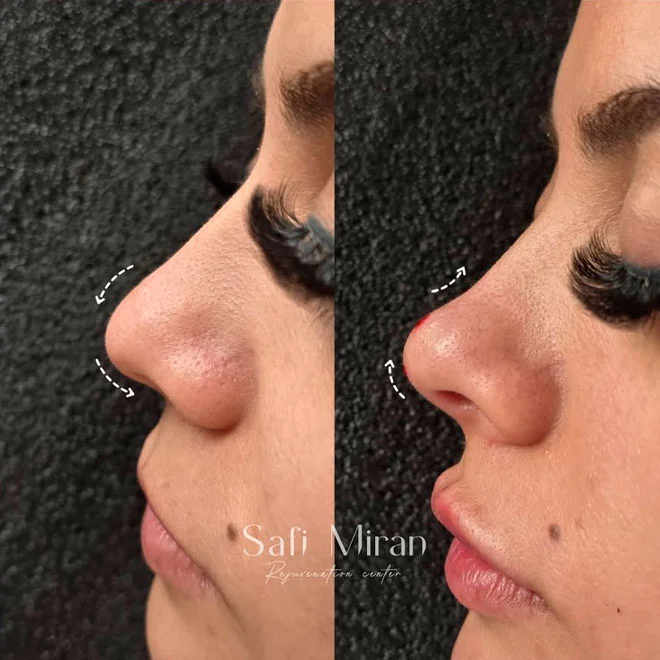 Before and after non-surgical rhinoplasty