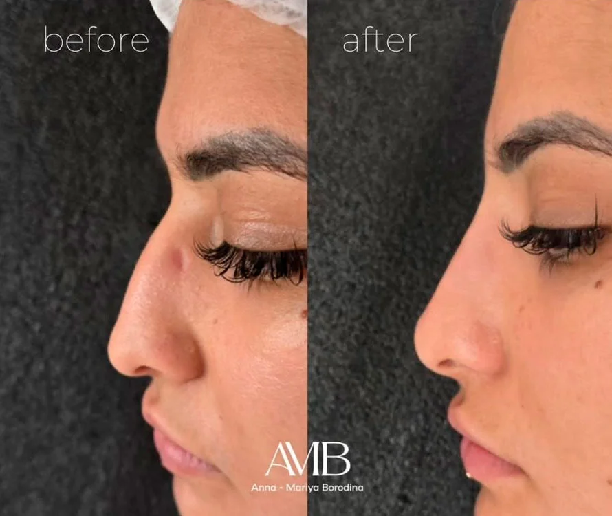 Non-surgical rhinoplasty before and after photo