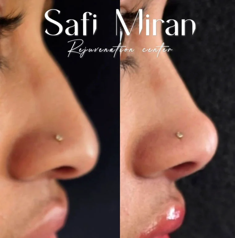 Non-surgical rhinoplasty before and after result