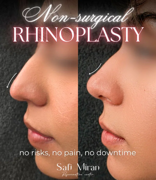 Non-surgical rhinoplasty result before and after